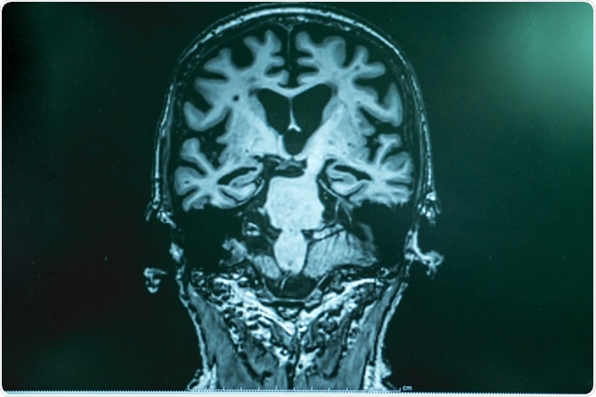 Alzheimer's disease with MRI. Image Credit: Atthapon Raksthaput / Shutterstock
